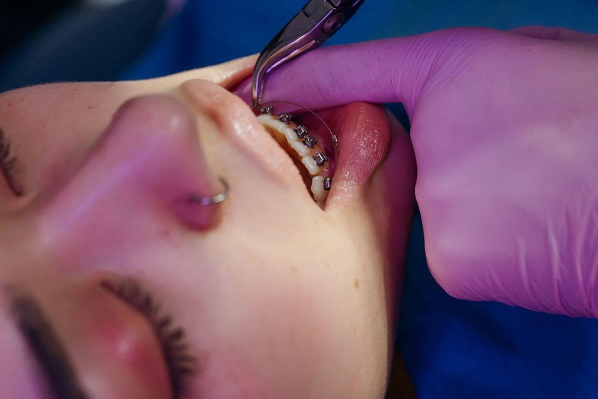 Zahnärztin legt mit Werkzeug Brackets an den Zähnen einer Patientin an